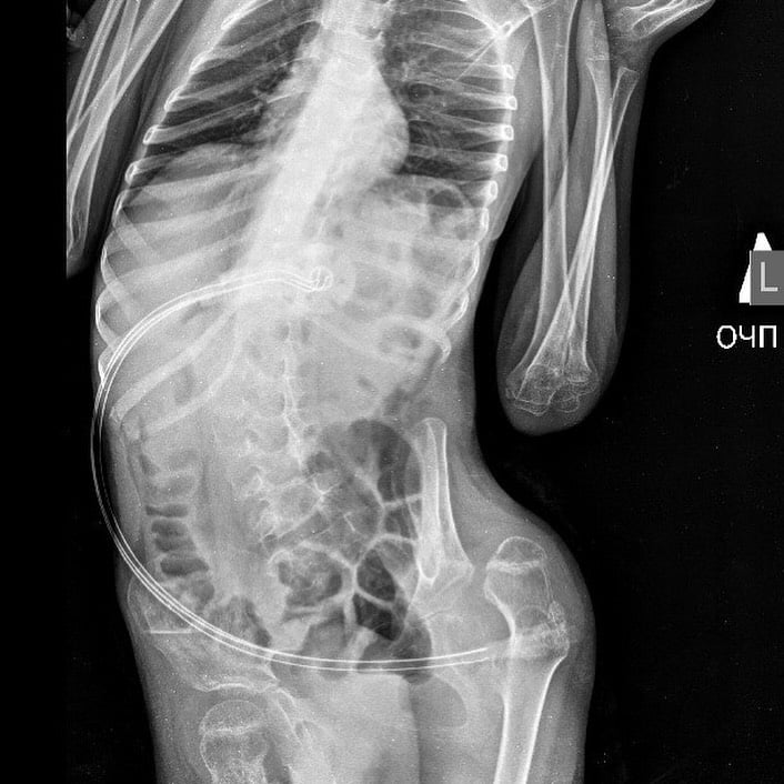 У Рівному 6-річному хлопчику встановили ПЕГ-гастростому (фото Максима Краська)