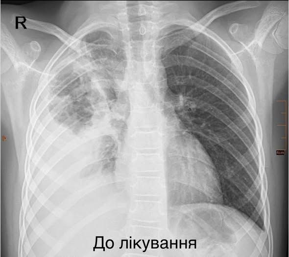 Легені дитини на момент госпіталізації