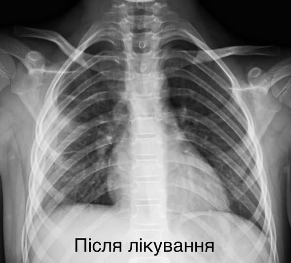 Легені маленької пацієнтки після лікування