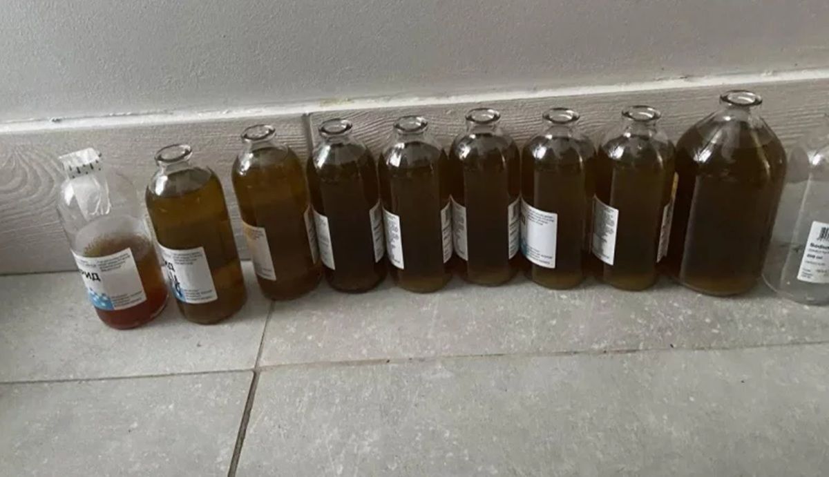 Лікарі викачали з ділянки біля серця буковинки майже 2,5 літра рідини