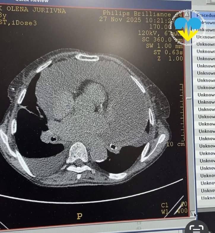На фото МРТ видно навколосерцеву сумку з рідиною 