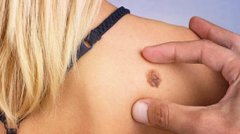 В Україні вперше закупили препарат для інноваційного лікування меланоми