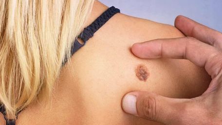 В Україні вперше закупили препарат для інноваційного лікування меланоми