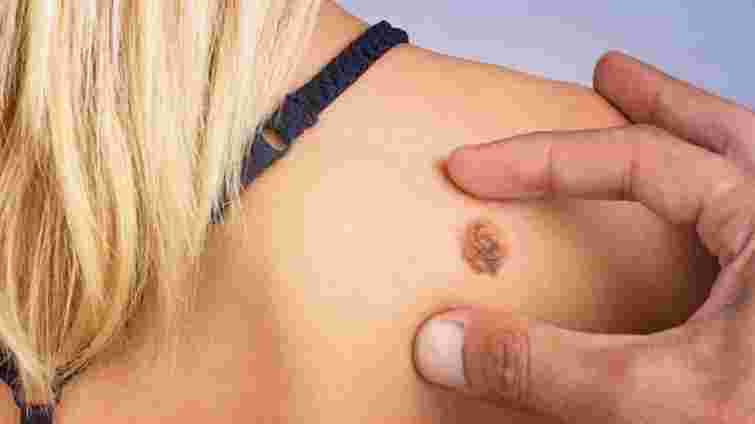 В Україні вперше закупили препарат для інноваційного лікування меланоми