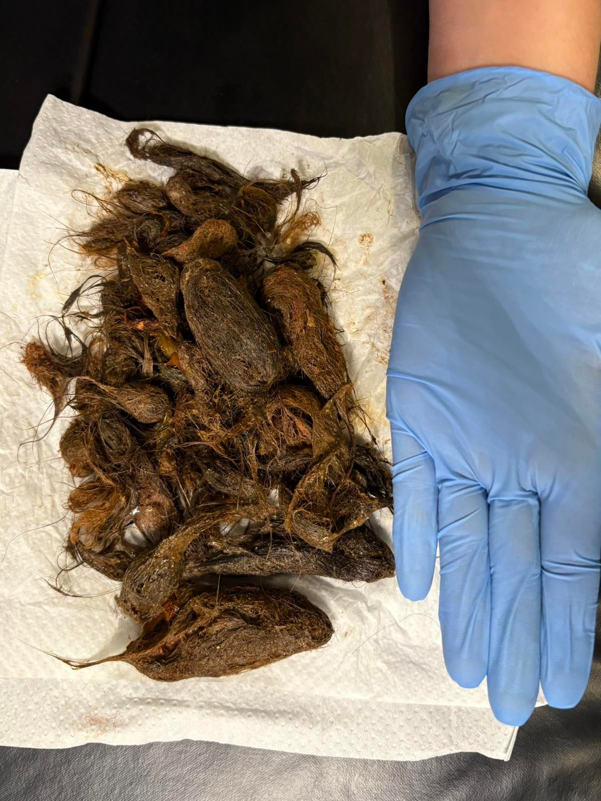 Зі шлунка дівчинки видалили трихобезоар вагою 700 грамів (фото Волинської обласної дитячої  лікарні)