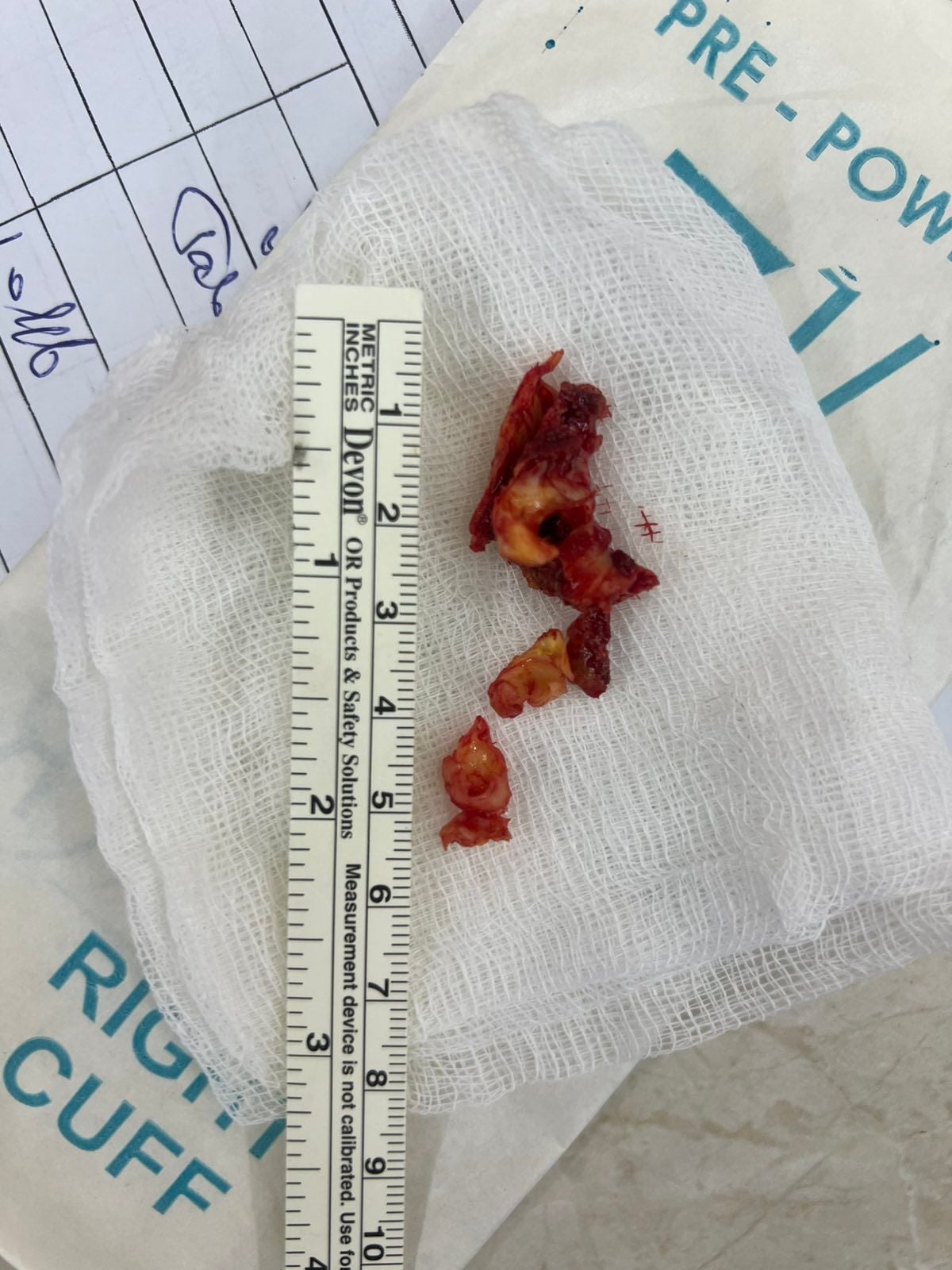 Ці бляшки судинні хірурги забрали з сонної артерії чоловіка. Фото лікарні