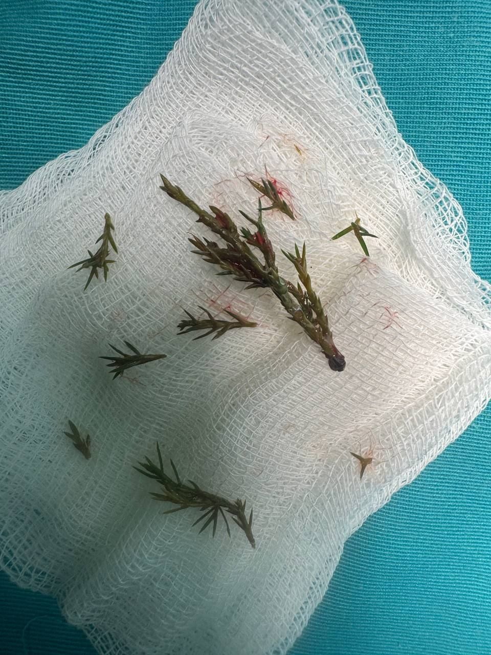 Стороннім тілом у дихальних шляхах хлопчика були гілочки ялинки