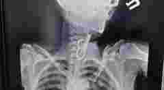 У Гусятині лікарі витягнули зі стравоходу 40-річної пацієнтки ключ від дверей