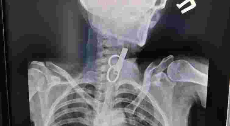 У Гусятині лікарі витягнули зі стравоходу 40-річної пацієнтки ключ від дверей