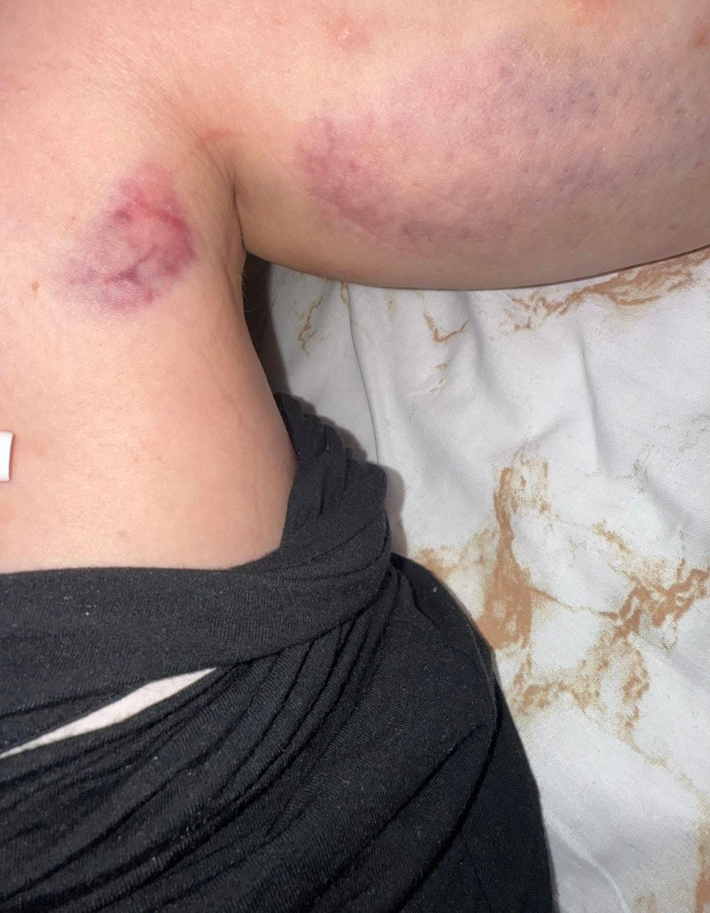 У результаті падіння дверей відвідувачка отримала травму стегна (фото постраждалої)