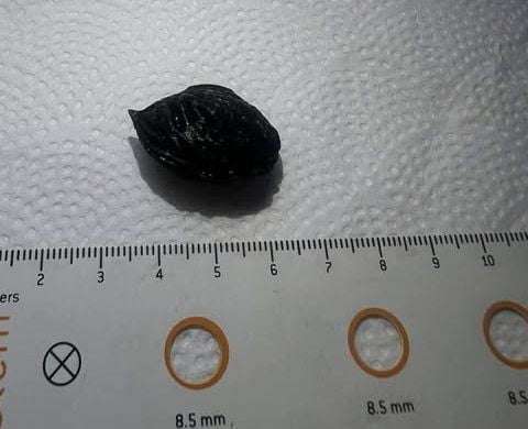 Пацієнт не пам'ятає, коли проковтнув кісточку персика