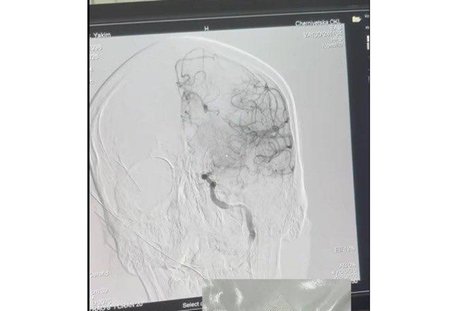 Медики врятували в Чернівцях 30-річного чоловіка з гострим ішемічним інсультом