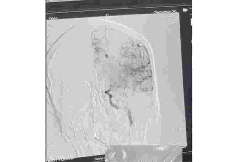 Медики врятували в Чернівцях 30-річного чоловіка з гострим ішемічним інсультом
