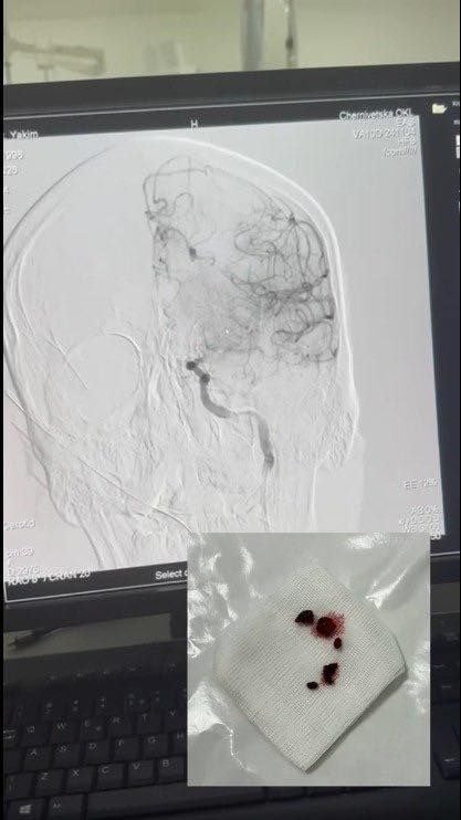 Лікарі видалили тромби з судини