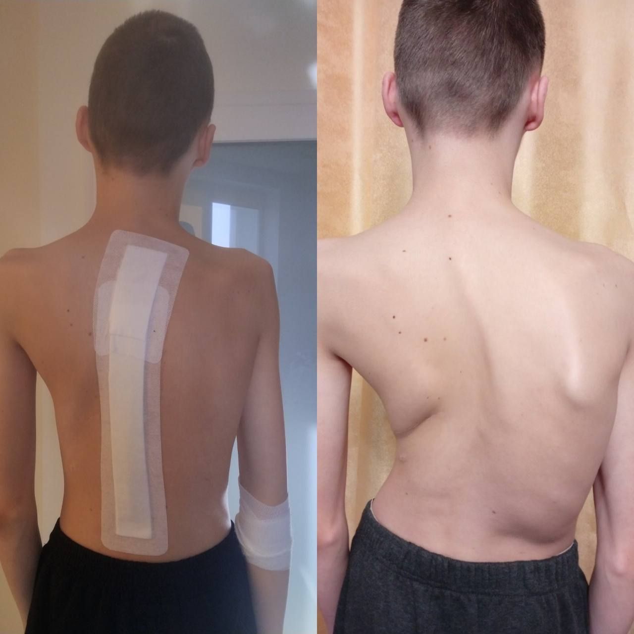 Хребет хлопця до і після операції