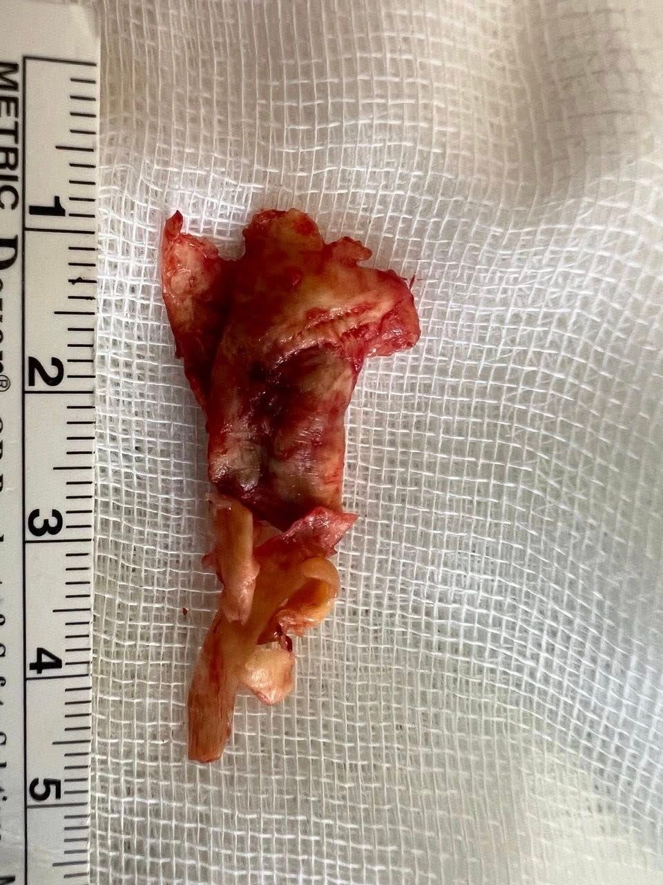 Бляшка, яка зукупорювала просвіт сонної артерії