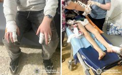 Собаки напали на двох малолітніх хлопців біля підприємства на Рівненщині