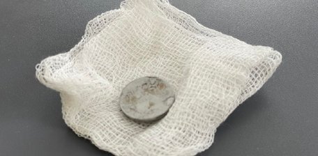 Хірурги Львова дістали зі стравоходу 2-річної дівчинки батарейку, з якою вона жила три місяці