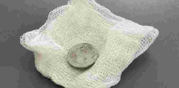 Хірурги Львова дістали зі стравоходу 2-річної дівчинки батарейку, з якою вона жила три місяці