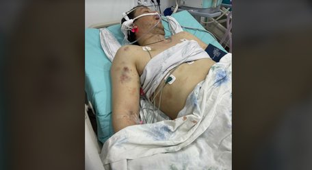 «Він вибіг з намету і почав битися головою об дерево»