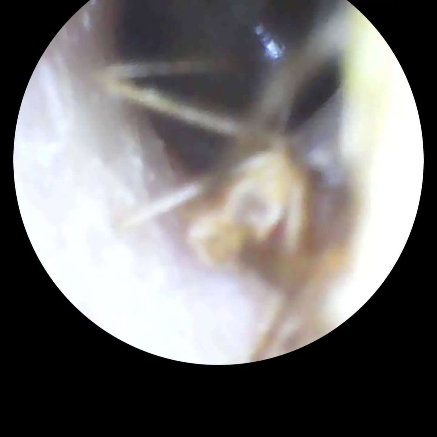 Павук проник доволі глибоко, майже до барабанної перетинки