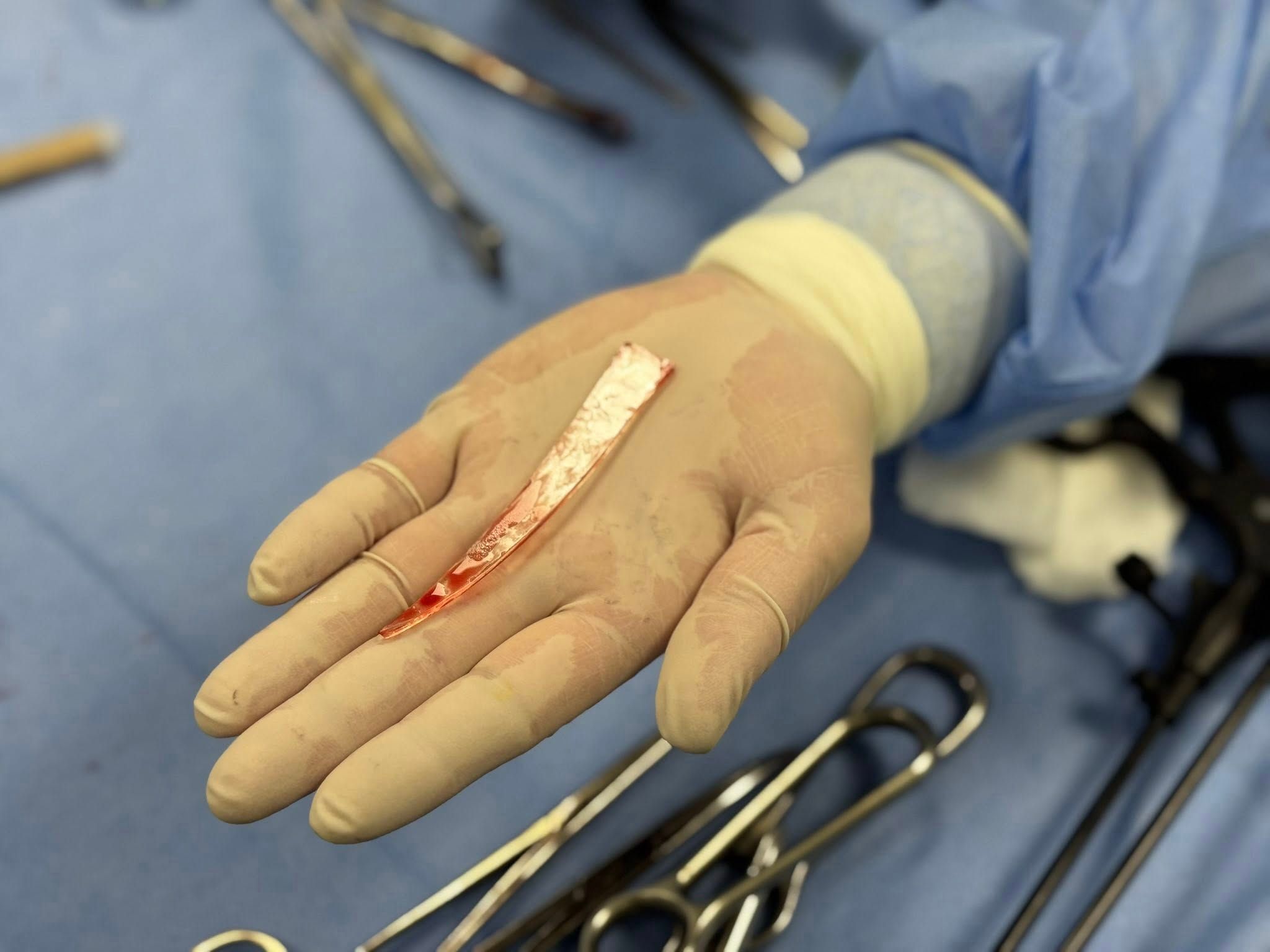 Ось цей уламок скла дістали з легені пацієнта