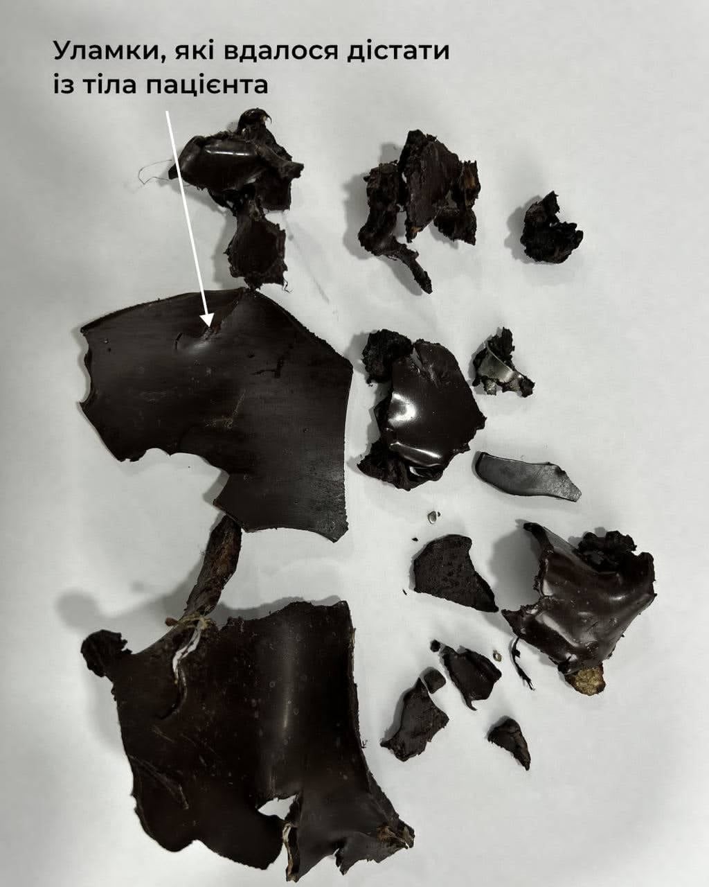Уламки, які дістали з тіла пацієнта. Фото лікарні