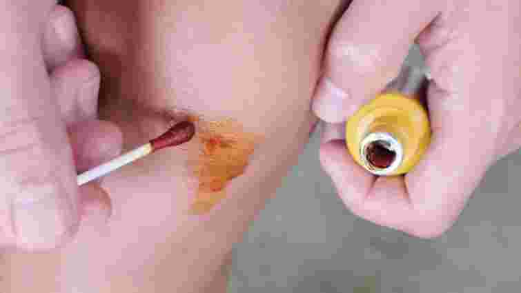 Безпечні і прості варіанти: чим швидко відмити йод зі шкіри та нігтів