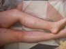 Відпочивальники масово скаржаться на свербіж і висипання після купання в озері Світязь 