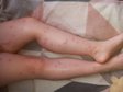 Відпочивальники масово скаржаться на свербіж і висипання після купання в озері Світязь 