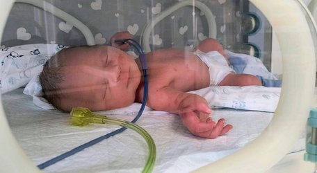 Лікарям вдалося після відходження вод ще 97 днів зберігали вагітність 28-річної пацієнтки