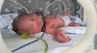 Лікарям вдалося після відходження вод ще 97 днів зберігали вагітність 28-річної пацієнтки