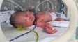 Лікарям вдалося після відходження вод ще 97 днів зберігали вагітність 28-річної пацієнтки