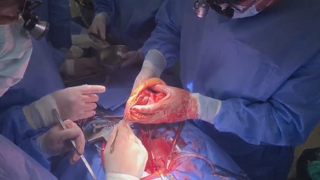 У Львові вперше провели операцію з пересадки серця