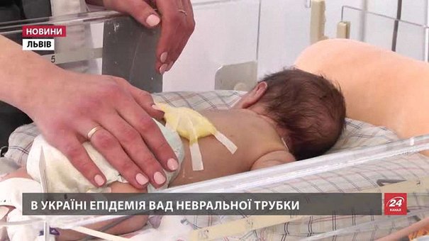 В Україні епідемія вроджених вад розвитку, які викликають важкі каліцтва у немовлят